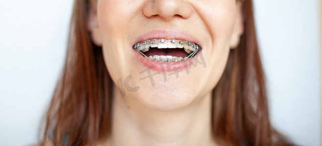 女人笑了笑，露出一口洁白整齐的戴着牙套的牙齿。