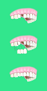 假牙种植学