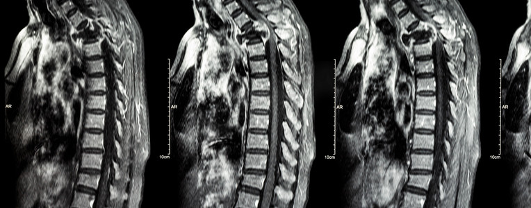 矢摄影照片_脊柱转移（癌症扩散到胸椎）（颈椎和胸椎的MRI：显示胸椎转移并压迫脊髓（脊髓病））（矢状面）