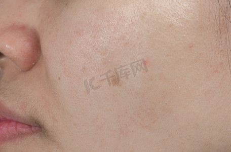 亚洲女性面部皮肤上的粉刺斑点。