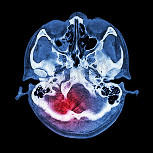 脑损伤、中风：（大脑和颅底 CT 扫描）（骨窗）