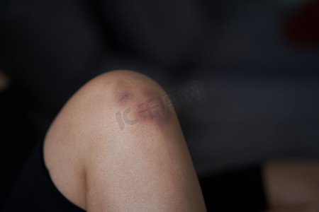 按摩受伤膝关节的人的特写镜头。