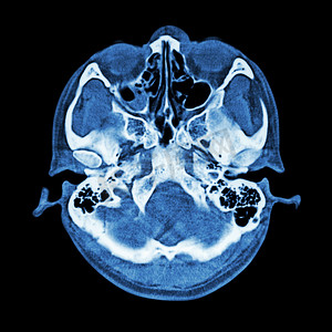 大脑和颅底的 CT 扫描（骨窗）