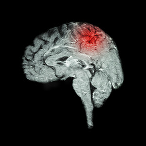 大脑和中风的磁共振成像 (MRI)（医学、科学和保健概念）
