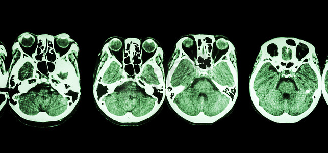 大脑和颅底CT扫描（显示眼睛、筛窦、小脑、大脑等结构）