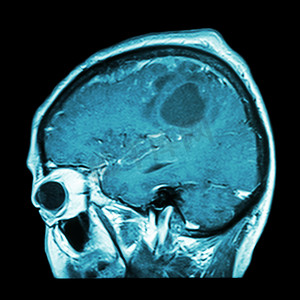 脑肿瘤的大脑胶片 MRI（矢状面、侧视图、侧视图）（医疗、保健、科学背景）