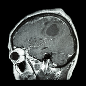 脑肿瘤的大脑胶片 MRI（矢状面、侧视图、侧视图）（医疗、保健、科学背景）