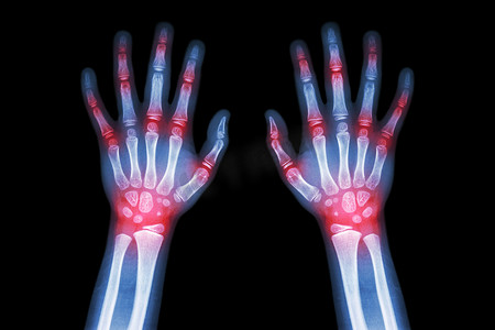 类风湿性关节炎、痛风性关节炎（患有多发性关节炎的儿童的 X 光片双手）（医疗、科学和保健概念）