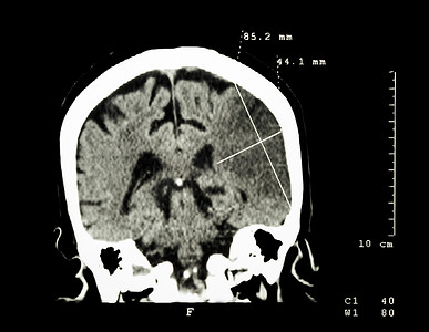 半球背景摄影照片_左半球脑梗塞（缺血性中风）（大脑 CT 扫描）：医学和科学背景