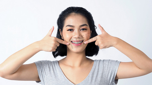 戴着牙套的亚洲青少年面部对着镜头微笑以展示正畸