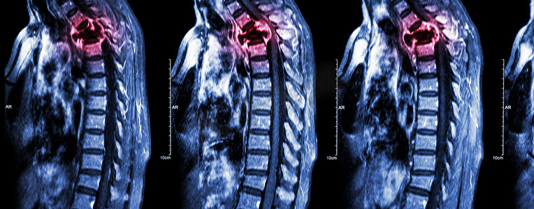 脊柱转移（癌症扩散到胸椎）（颈椎和胸椎的MRI：显示胸椎转移并压迫脊髓（脊髓病））（矢状面）