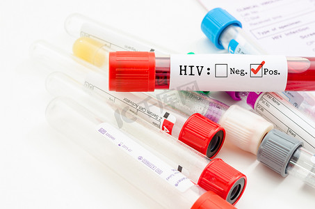 艾滋病疫苗摄影照片_带 HIV 检测的采血管样本。