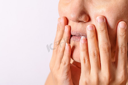 鼻子摄影照片_过敏女性在冬季有湿疹干燥的鼻子和嘴唇