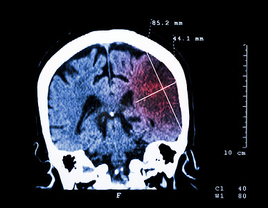 左半球脑梗塞（缺血性中风）（大脑 CT 扫描）：医学和科学背景