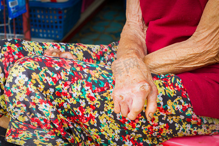 特写患有麻风病的老妇人的手，被截肢的汉