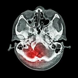 脑损伤、中风：（大脑和颅底 CT 扫描）（骨窗）