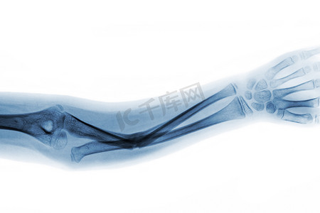 影片 X 射线前臂 AP 显示尺骨骨折轴