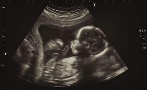 第 4 个月胎儿的超声检查分析