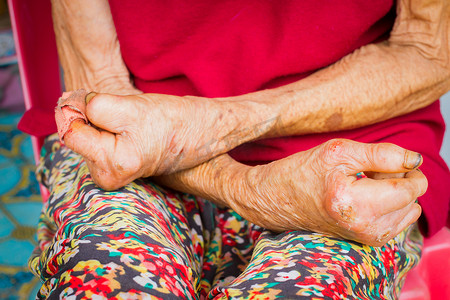人类的皮肤摄影照片_特写患有麻风病的老妇人的手，被截肢的汉