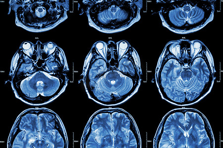 大脑 MRI（大脑横截面）（医学、保健、科学背景）