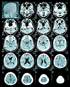 大脑的 MRI 扫描图像。