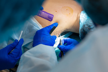 美容痣摄影照片_特写外科医生在病人的背部烧了一颗痣。
