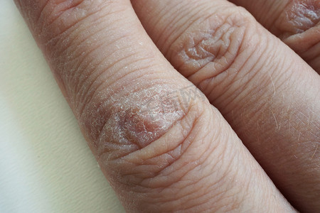 皮肤干燥开裂的手的特写。