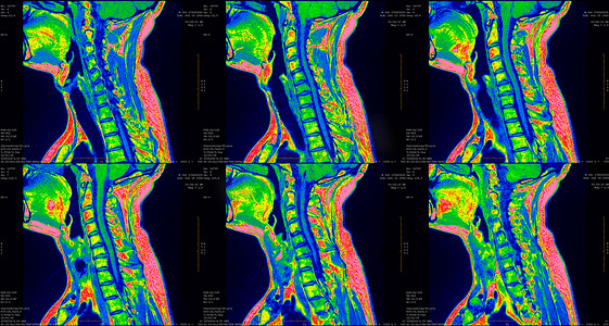 矢摄影照片_34 岁白种男性颈部区域的 6 组矢状绿色 MRI 扫描，双侧旁内侧挤压 C6-C7 段