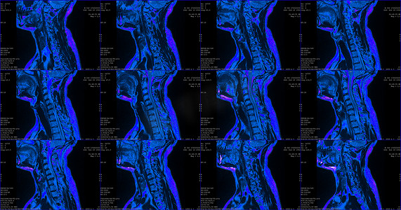 34 岁白人男性颈部 12 幅矢状蓝色 MRI 扫描，双侧旁内侧挤压 C6-C7 节段