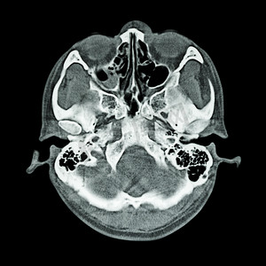 脑卒中卡通摄影照片_大脑和颅底的 CT 扫描（骨窗）