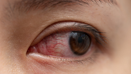 眼睛炎症摄影照片_特写镜头的刺激或感染红色充血的眼睛-结膜