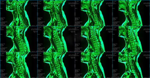 34 岁白种男性颈部区域的 6 组矢状绿色 MRI 扫描，双侧旁内侧挤压 C6-C7 段