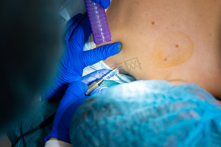 美容痣摄影照片_特写外科医生在病人的背部烧了一颗痣。