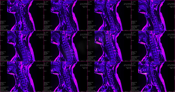 34 岁白种男性颈部区域的 6 组矢状绿色 MRI 扫描，双侧旁内侧挤压 C6-C7 段