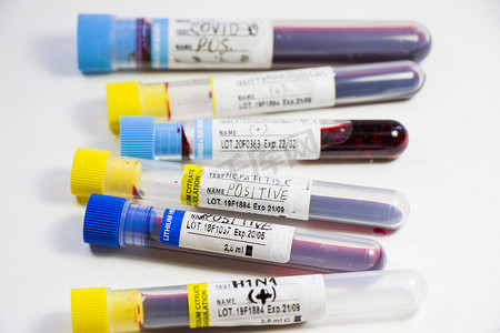 H1N1、Covid-19、丙型肝炎、结核病和葡萄球菌病毒在试管中进行血液检测，实验室诊断