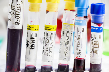 H1N1、Covid-19、丙型肝炎、结核病和葡萄球菌病毒在试管中进行血液检测，实验室诊断