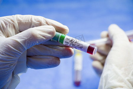艾滋病毒和艾滋病感染检测、蓝色背景上带血的手和管。