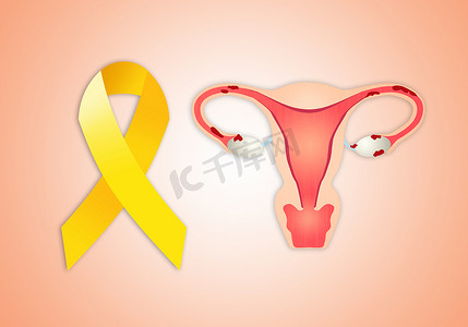 子宫内膜异位症与黄丝带