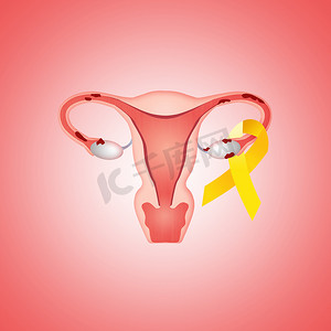 有子宫内膜异位症和黄丝带的子宫