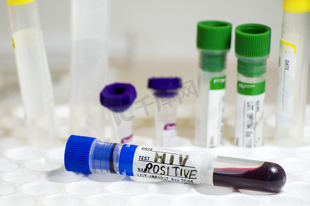 艾滋病毒和艾滋病感染血液检测样本、诊断和实验室化学液体元素