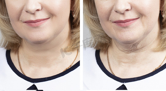手术摄影照片_整容手术前后老年妇女面部的一部分。老年妇女手术前后面部皱纹