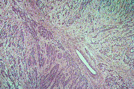 子宫肌瘤摄影照片_子宫病变组织的纤维肌瘤 100x