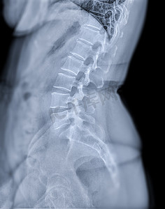 用于诊断腰痛的腰椎或 L-s 脊柱侧视图的 X 射线图像。