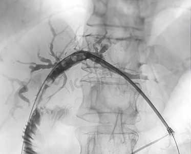 切除术摄影照片_医生在现代手术室内进行 ERCP 和腹腔镜胆囊切除术后门静脉的 X 射线图像。
