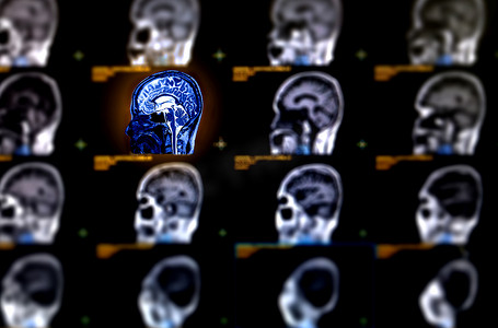 MRI 脑轴向视图的选择性聚焦，用于检测脑卒中疾病的各种情况。
