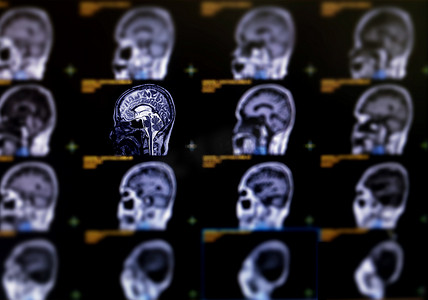 大脑结构摄影照片_MRI 大脑矢状面的选择性聚焦，用于检测大脑的各种状况，例如囊肿、肿瘤、出血、肿胀、发育和结构异常或感染。