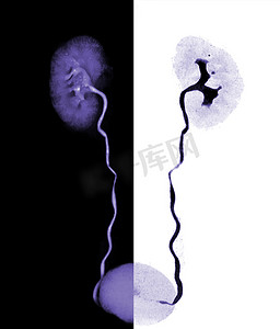 CTA 肾动脉 3D 渲染图像显示肾脏、输尿管和膀胱。