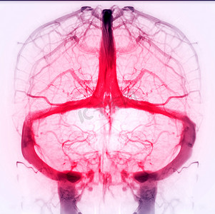 血型摄影照片_用于诊断脑静脉血栓形成的脑静脉造影术