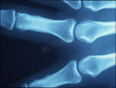 X 射线图像、人、有骨骼和关节的手