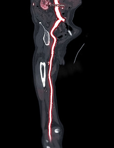 或股摄影照片_CTA 股动脉从 MPR 曲线上流出，显示左股动脉用于诊断急性或慢性外周动脉疾病。